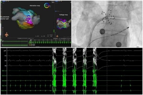 FARAPULSE脈沖電場(chǎng)消融新技術(shù)手術(shù)