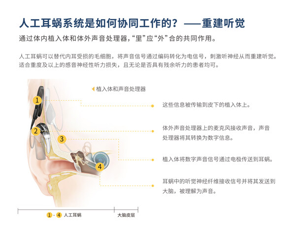 人工耳蝸的工作原理