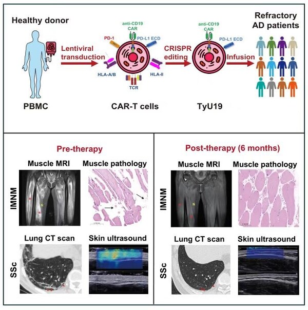 UCAR-T產品“TyU19”（BRL-303）治療策略