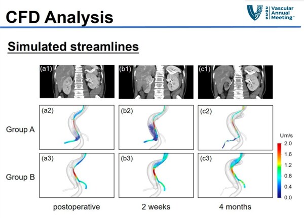主動(dòng)脈夾層術(shù)后腎臟缺血損害的動(dòng)態(tài)血流動(dòng)力學(xué)分析