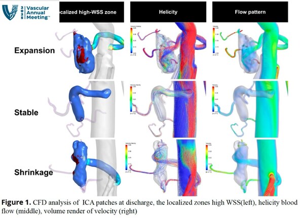 胸腹主動(dòng)脈替換術(shù)后，肋間動(dòng)脈片不同解剖形態(tài)的血流模式圖